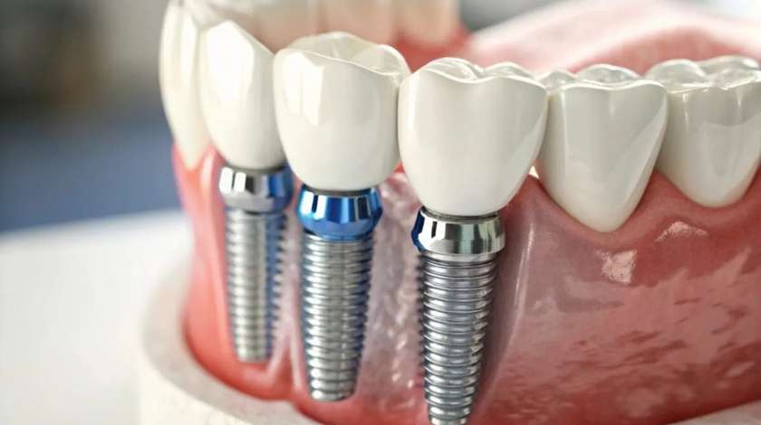 Impianti dentali